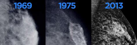 the villages breast cancer mammogram images|Mammograms & Other Types of Breast Exams.